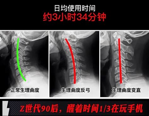 反弓|頸椎反弓：症狀、病因及如何治療